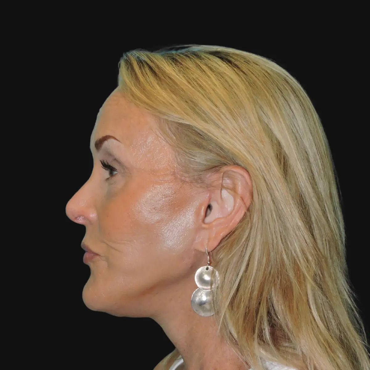 Lower facelift and neck lift after photo, case 10239, profile view