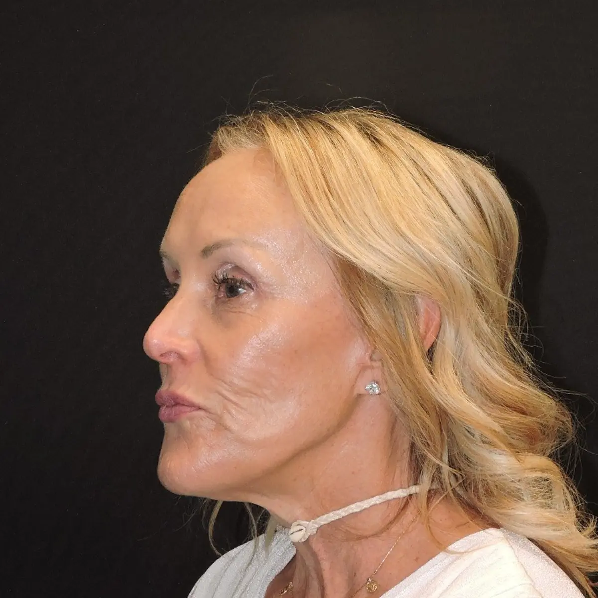 Lower facelift and neck lift before photo, case 10239, three-quarter view