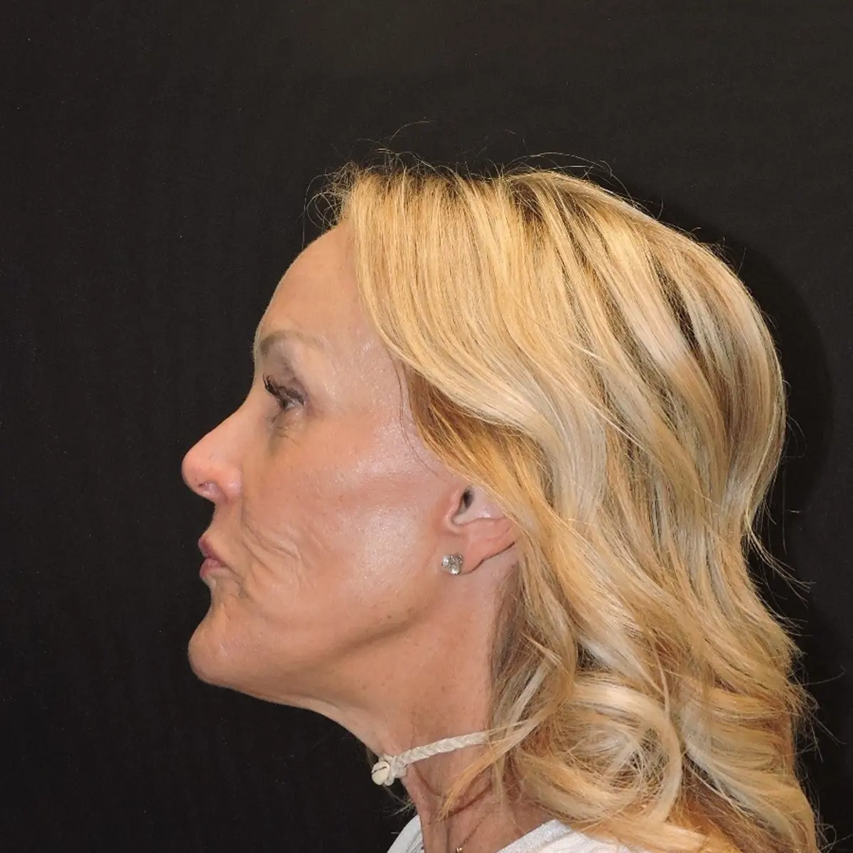 Lower facelift and neck lift before photo, case 10239, profile view