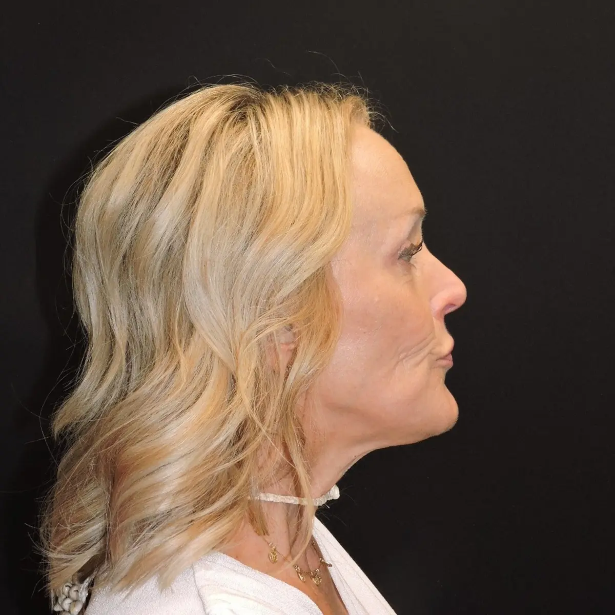Lower facelift and neck lift before photo, case 10239, opposite profile view
