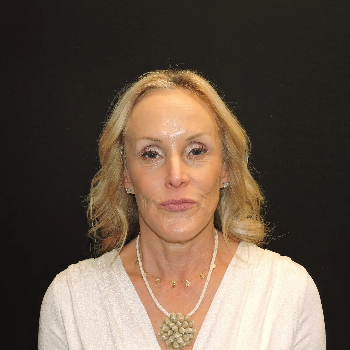 Lower facelift and neck lift before photo, case 10239, front view